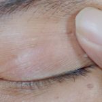 Expert Skin Tag Removal Clinic in Manchester